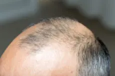 male baldness