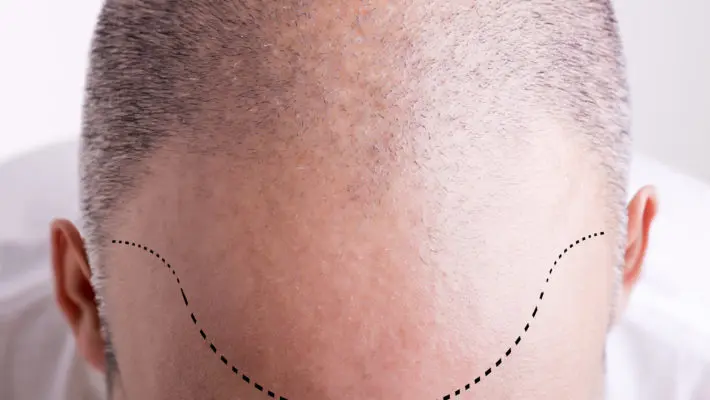 Hair Loss