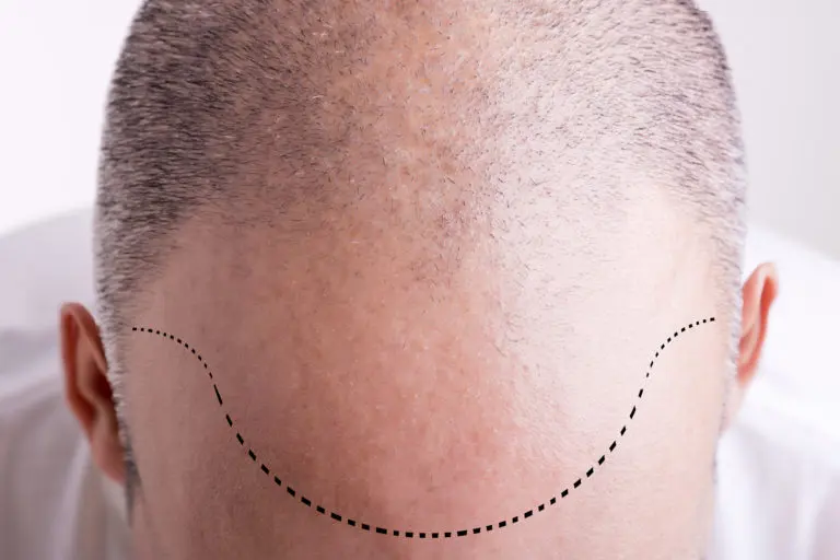 Hair Loss