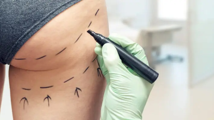 New curbs on cosmetic surgery ads