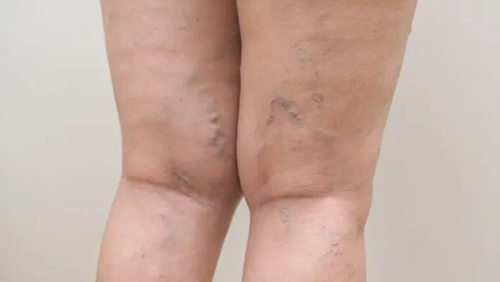 Many people experience tired legs, swelling, or cramps without realising these may be early signs of poor circulation. While some symptoms may seem harmless at first, they can signal underlying vein issues such as varicose veins, venous insufficiency, or even deep vein thrombosis (DVT).