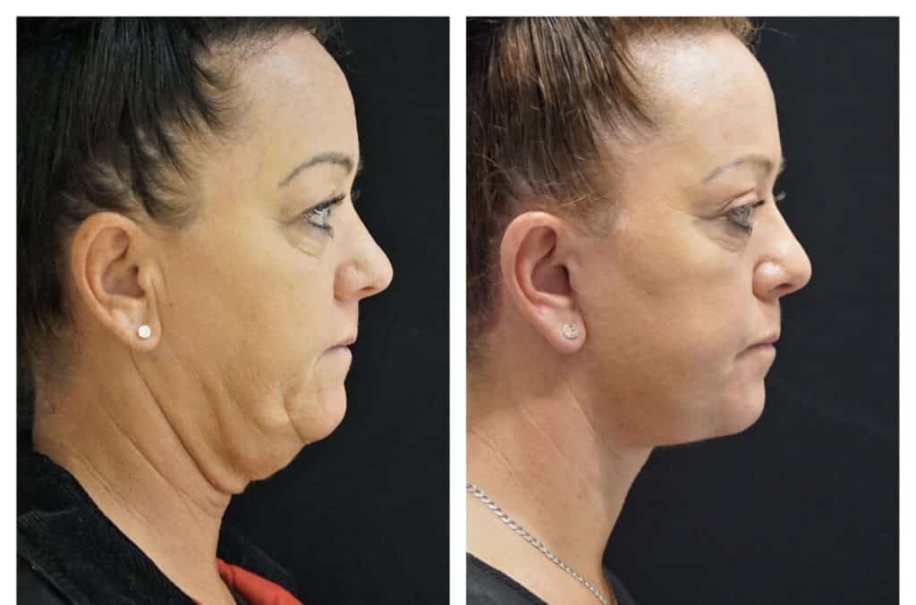 What is a neck lift?