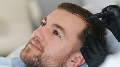 Turkey has become one of the first places people investigate when hair loss starts to affect their confidence. Istanbul, in particular, has developed an enormous hair restoration industry, with clinics treating patients from the UK, Germany, France, Italy, the Gulf countries and North America throughout the year.